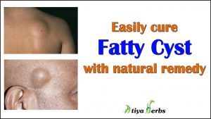 Easily cure Fatty Cyst with natural remedy