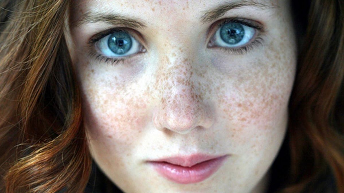 Freckles are small brown dots formed on skin. 