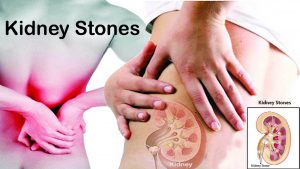 Kidney Stones – Prevention, Home Remedies, Herbal Treatment & Post treatment advice