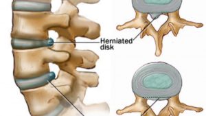 Take care of your Slip Disc problem before it becomes Sciatica
