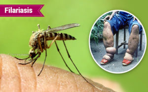 Filariasis- Let Not One Mosquito Disfigure You Forever