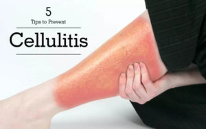 Cellulitis- Treat Your Skin Infection Before It’s Too Late
