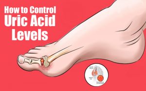 Higher Uric Acid in our Body is Alarming